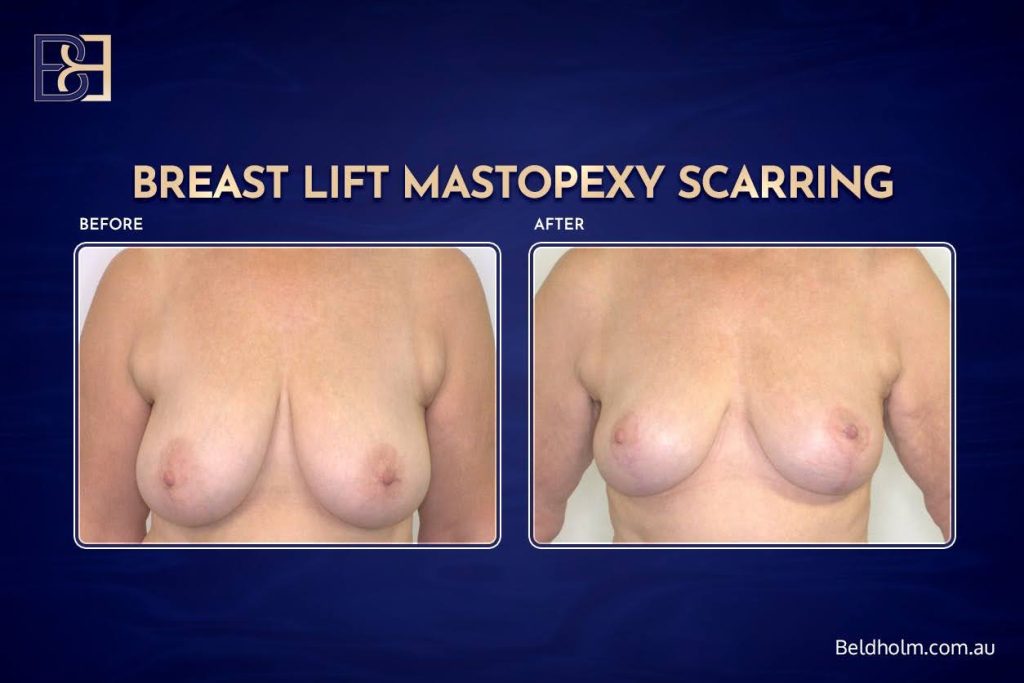 Breast Lift Mastopexy Scarring