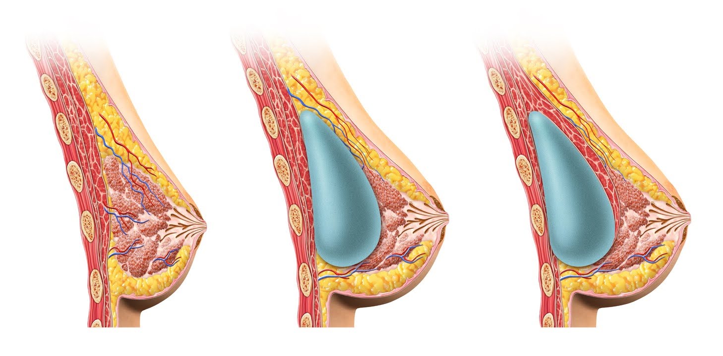 Breast augmentation (augmentation mammoplasty) with implants