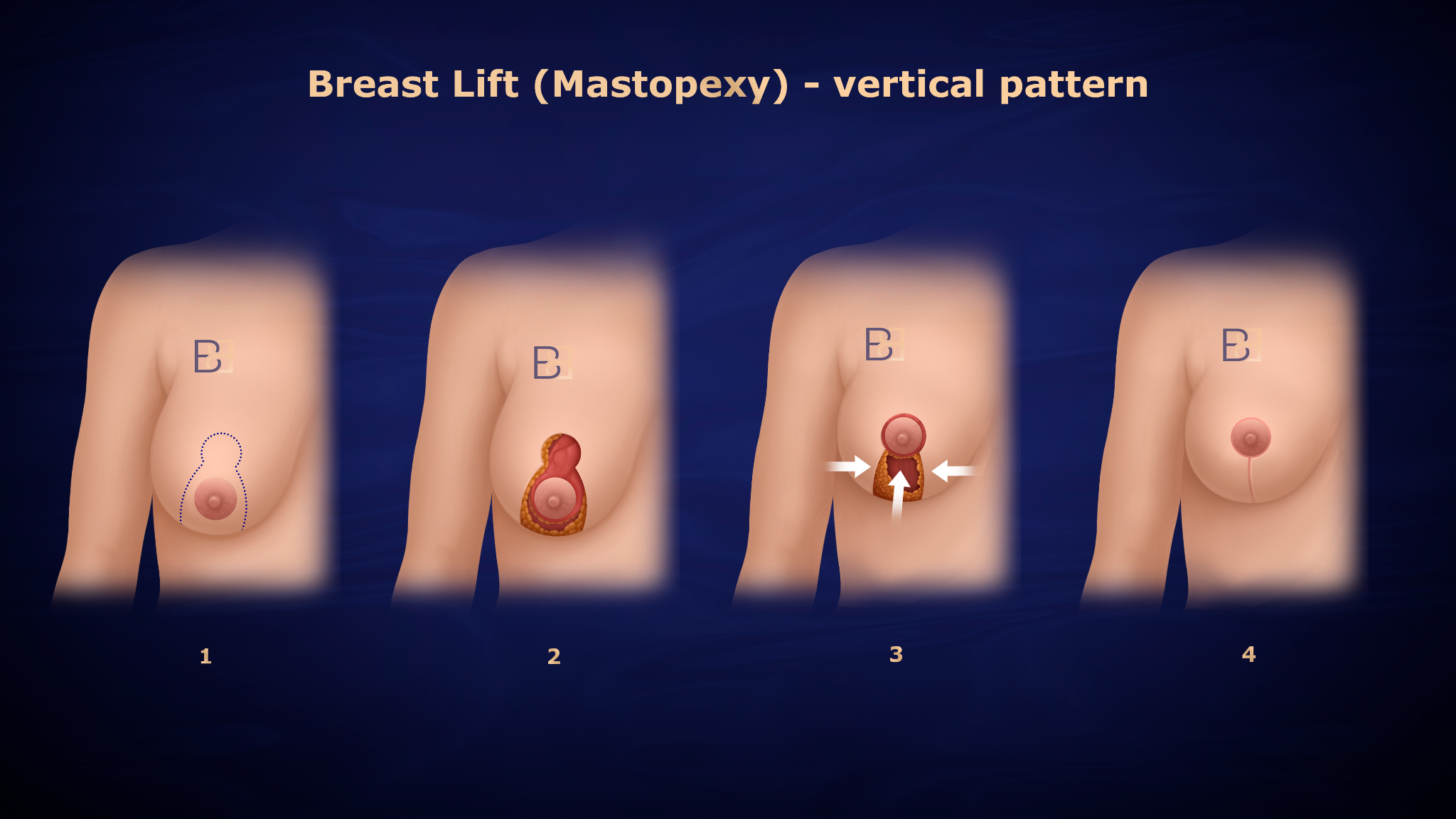 Breast lift (mastopexy) - vertical pattern - Dr Bernard Beldholm