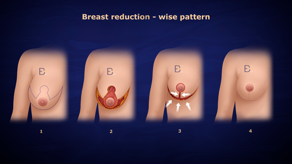 Breast Surgery: Reducing Breast Size, Lifting the Breast, Adding Volume, and Surgery for Existing Breast Implants 2 Breast reduction - wise pattern - Dr Bernard Beldholm