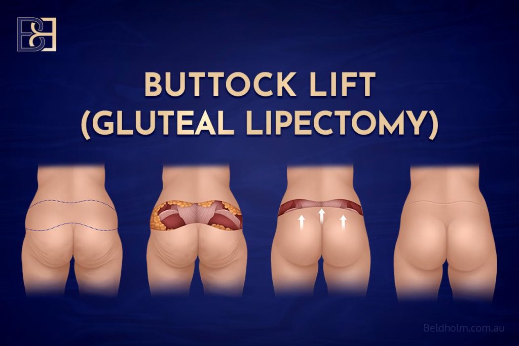 Gluteal Lipectomy (Buttock Lift Surgery) After Weight Loss in Newcastle NSW 2 What is a Gluteal Lipectomy (buttock lift)
