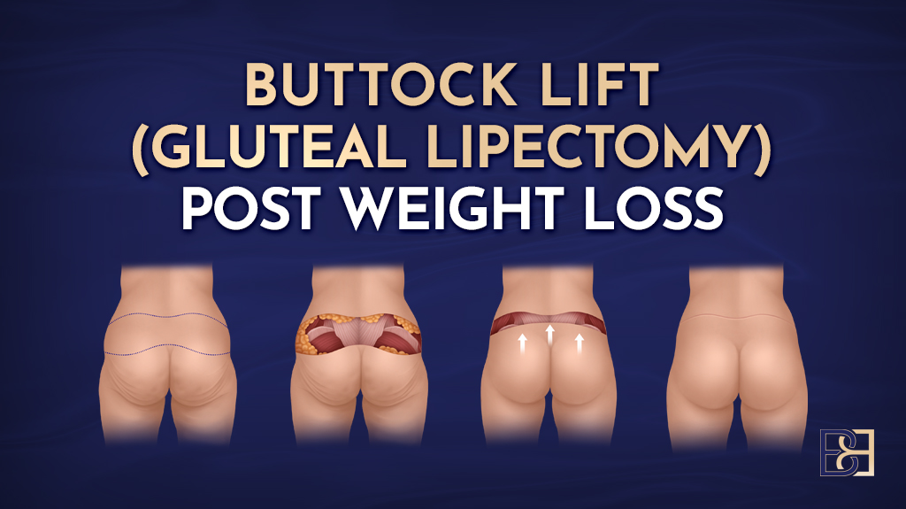 Buttock lift (gluteal lipectomy) post weight loss-featured image
