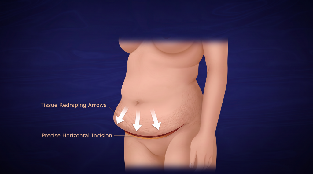 Closure and drains - Apronectomy