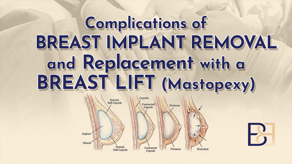 Complications of Breast Implant Removal and Replacement with a Breast Lift