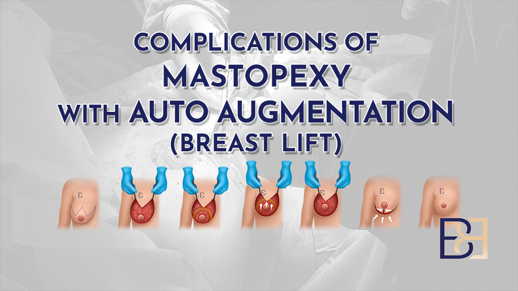 Complications of Mastopexy with Auto Augmentation (Breast Lift)-featured image
