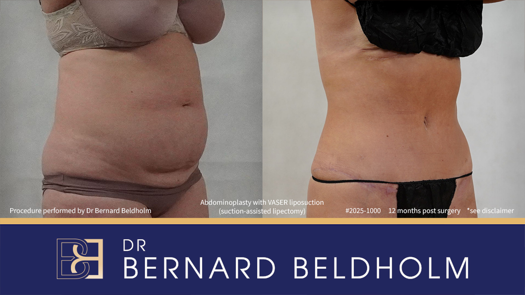 Patient 2025-1000 - Abdominoplasty with VASER Liposuction (Suction-assisted Lipectomy) Post Pregnancy and Diastasis Recti Repair - Left