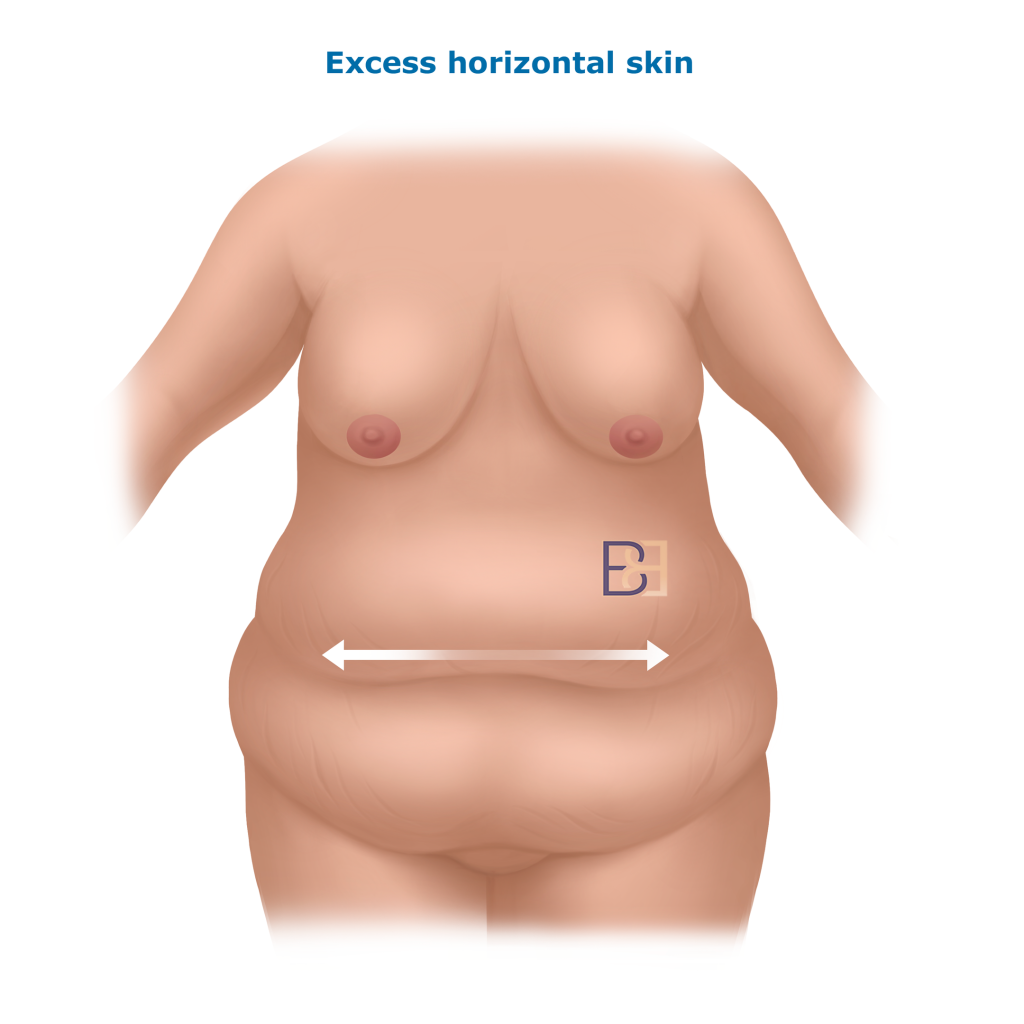 Excess Horizontal Skin