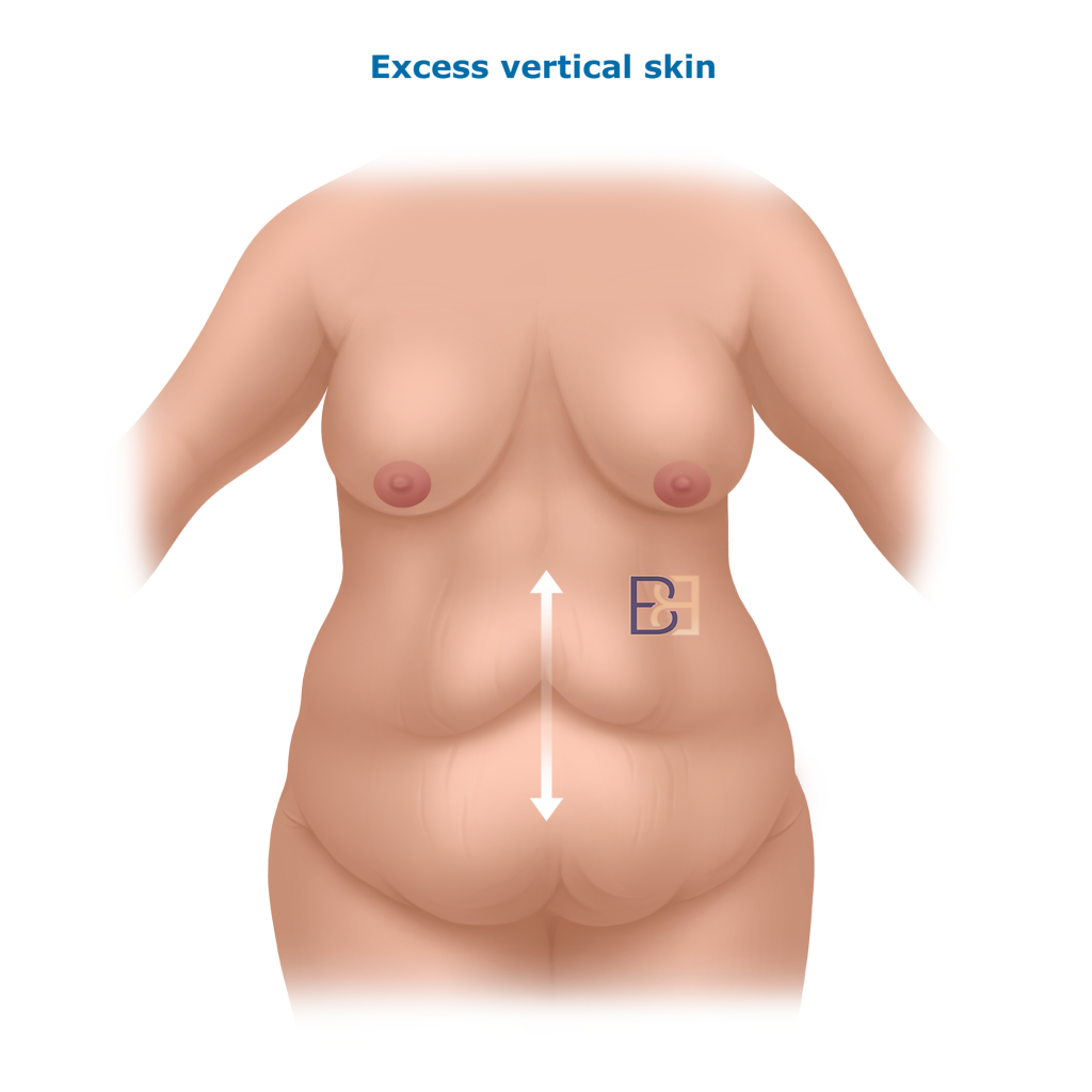 Excess Vertical Skin