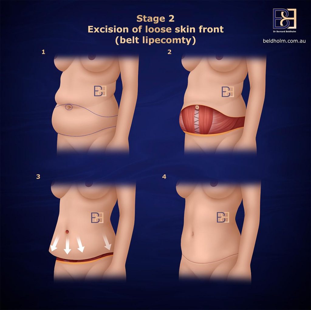 Excision of Loose Skin Front