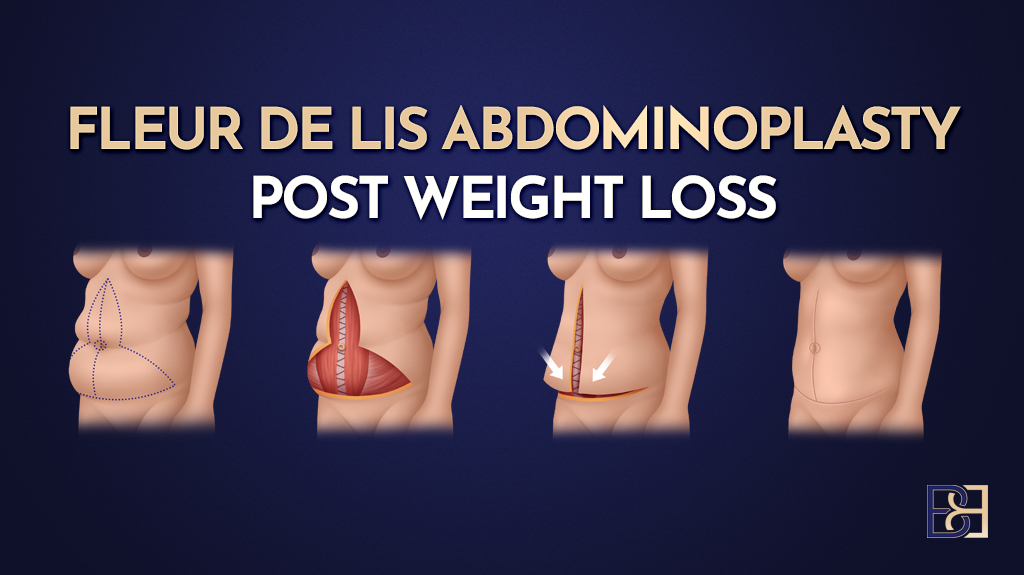 Fleur de lis abdominoplasty post weight losss-featured image