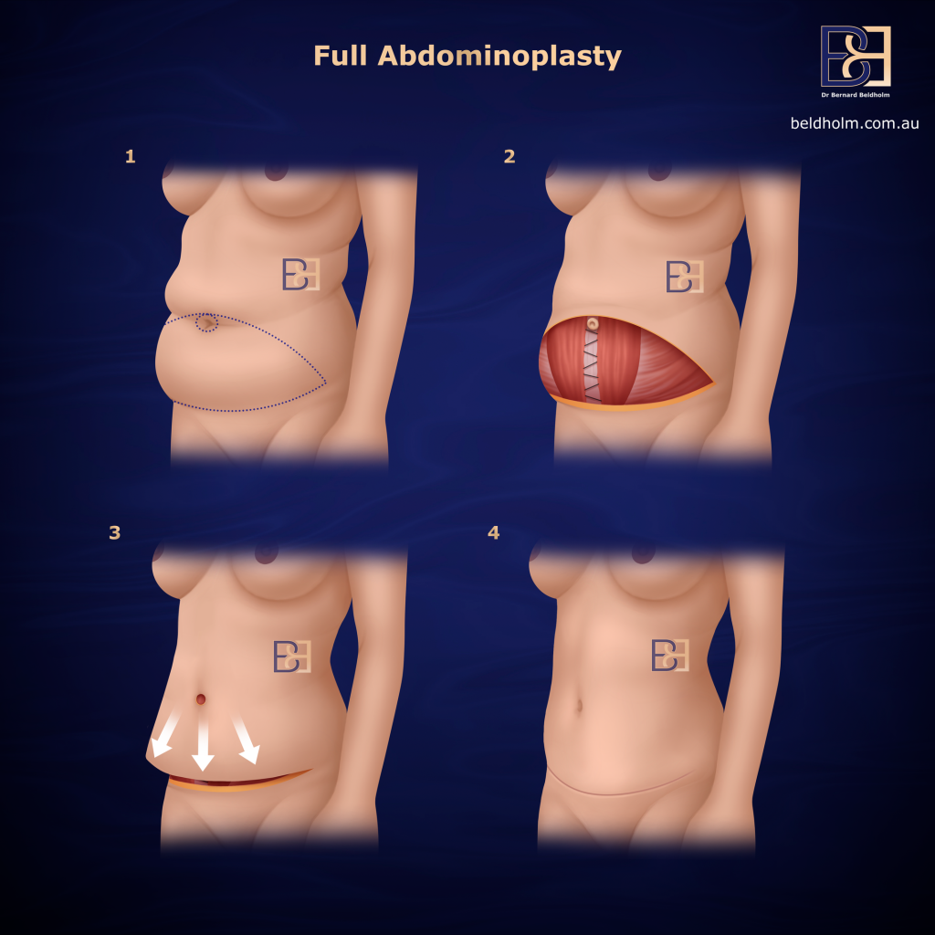 Full Abdominoplasty