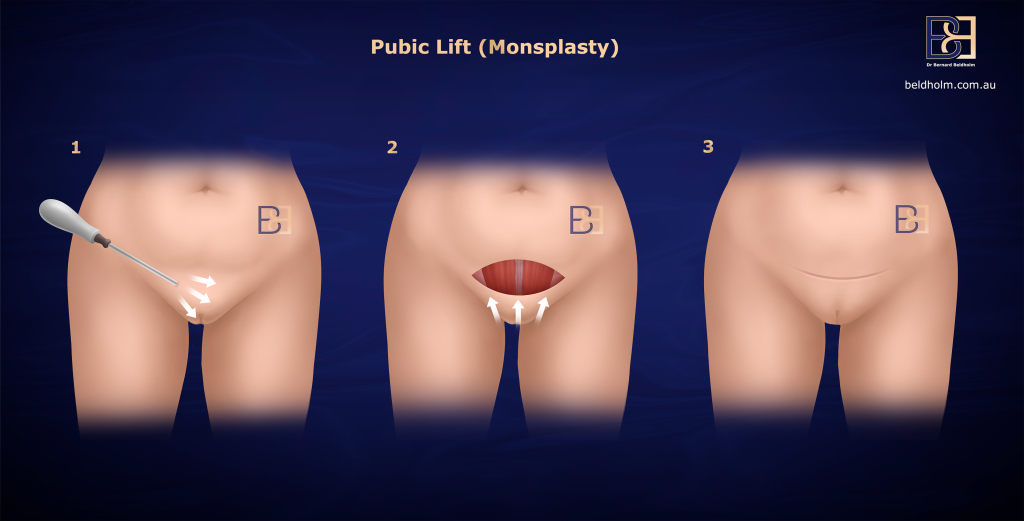 Pubic Lift (Monsplasty) Surgery in Newcastle NSW 2 How Monsplasty (pubic lift) Is Performed
