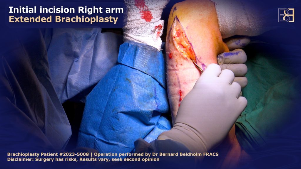 Initial Incision Right Arm - Extended Brachioplasty