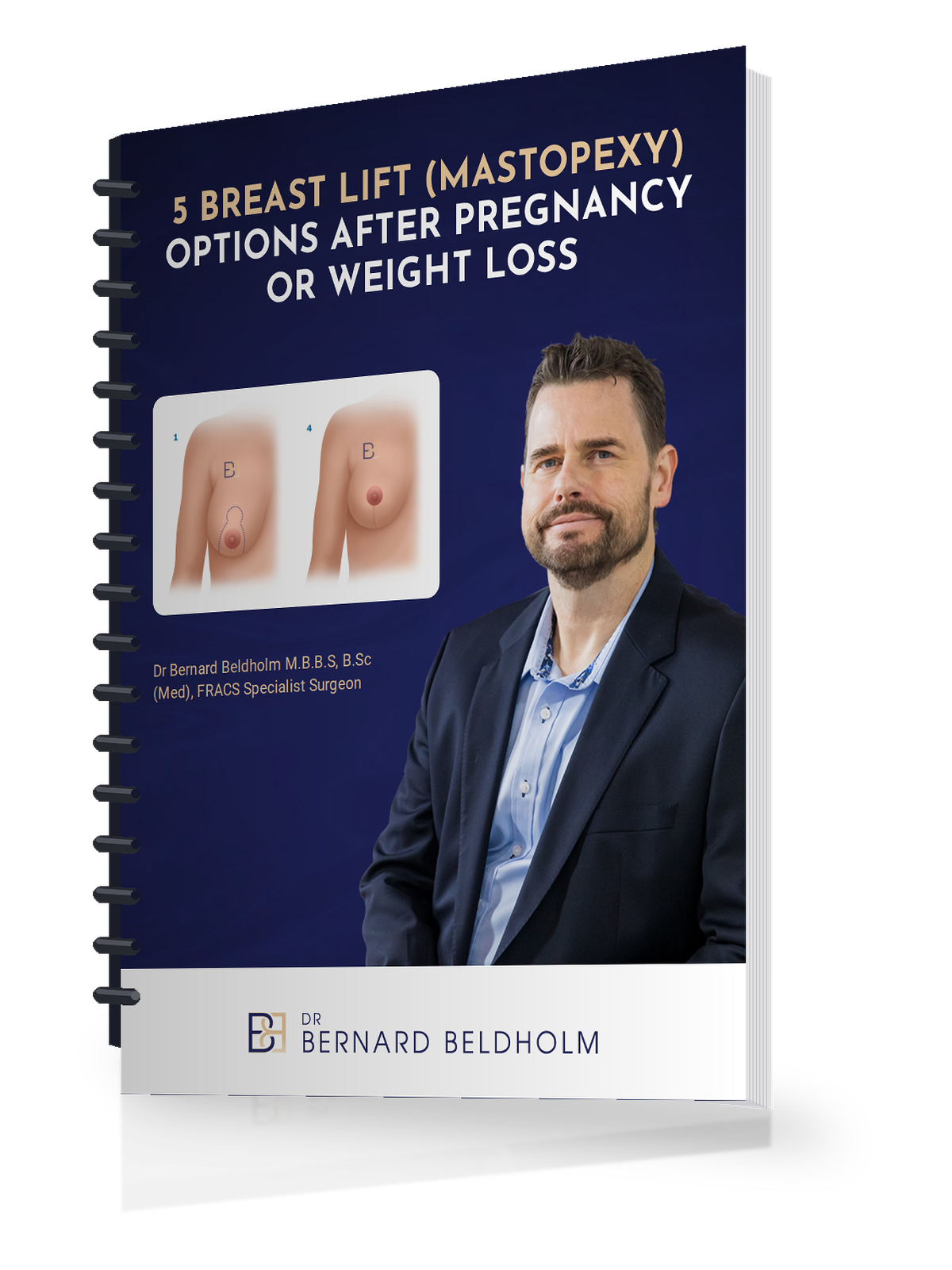 Recovery After Breast Implant Removal and Replacement With Breast Lift (Mastopexy) 2