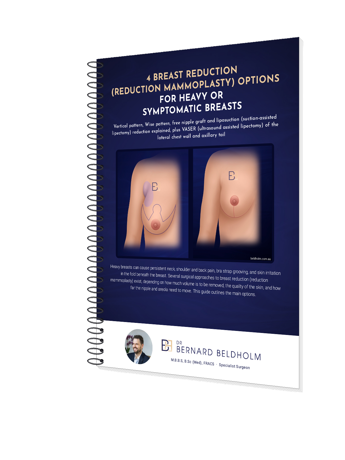 4 Breast Reduction (Reduction Mammoplasty) Options for Heavy or Symptomatic Breasts