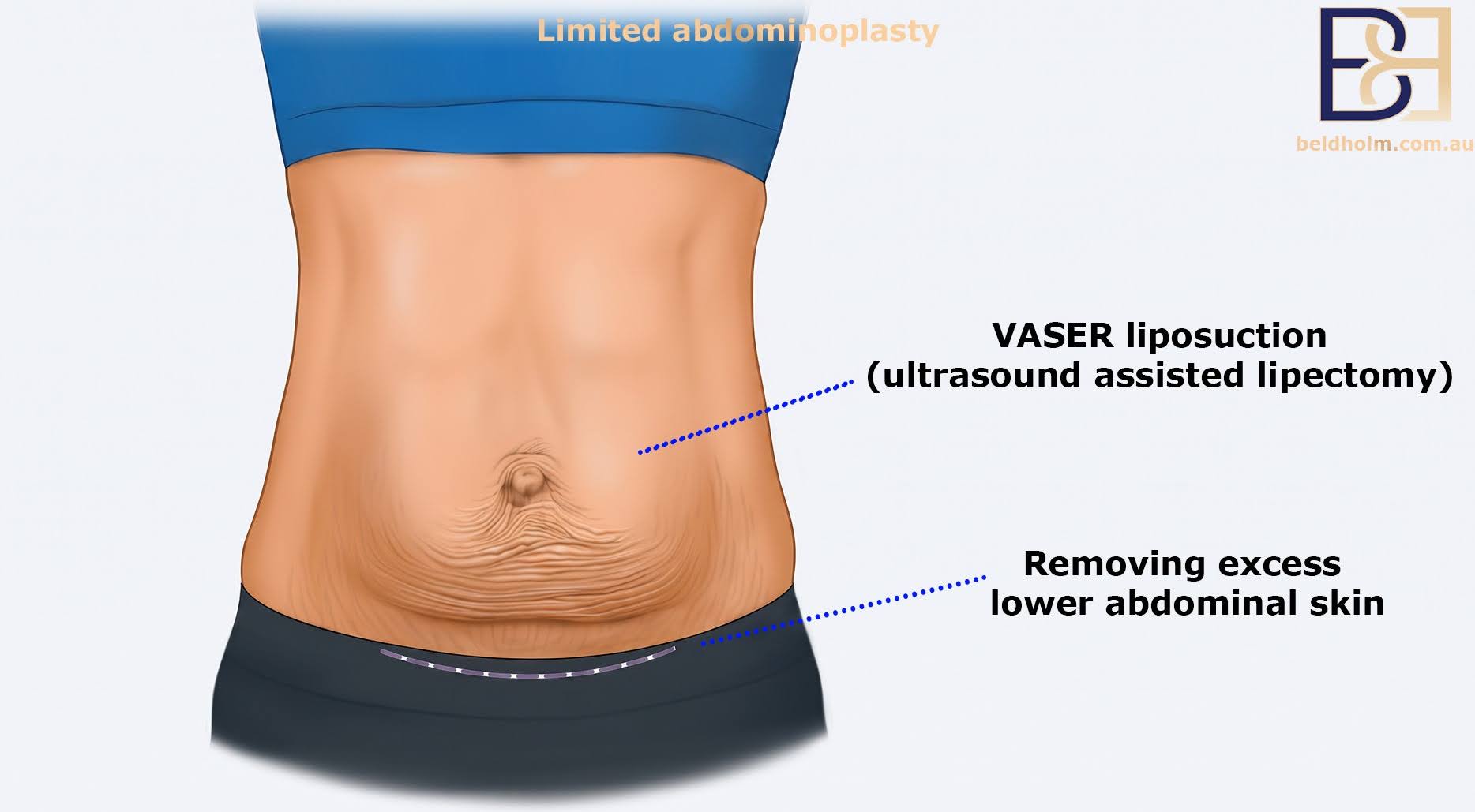 Limited Abdominoplasty (Mini Tummy Tuck) Cost After Pregnancy in Newcastle NSW 1 Limited Abdominoplasty (Mini Abdominoplasty)