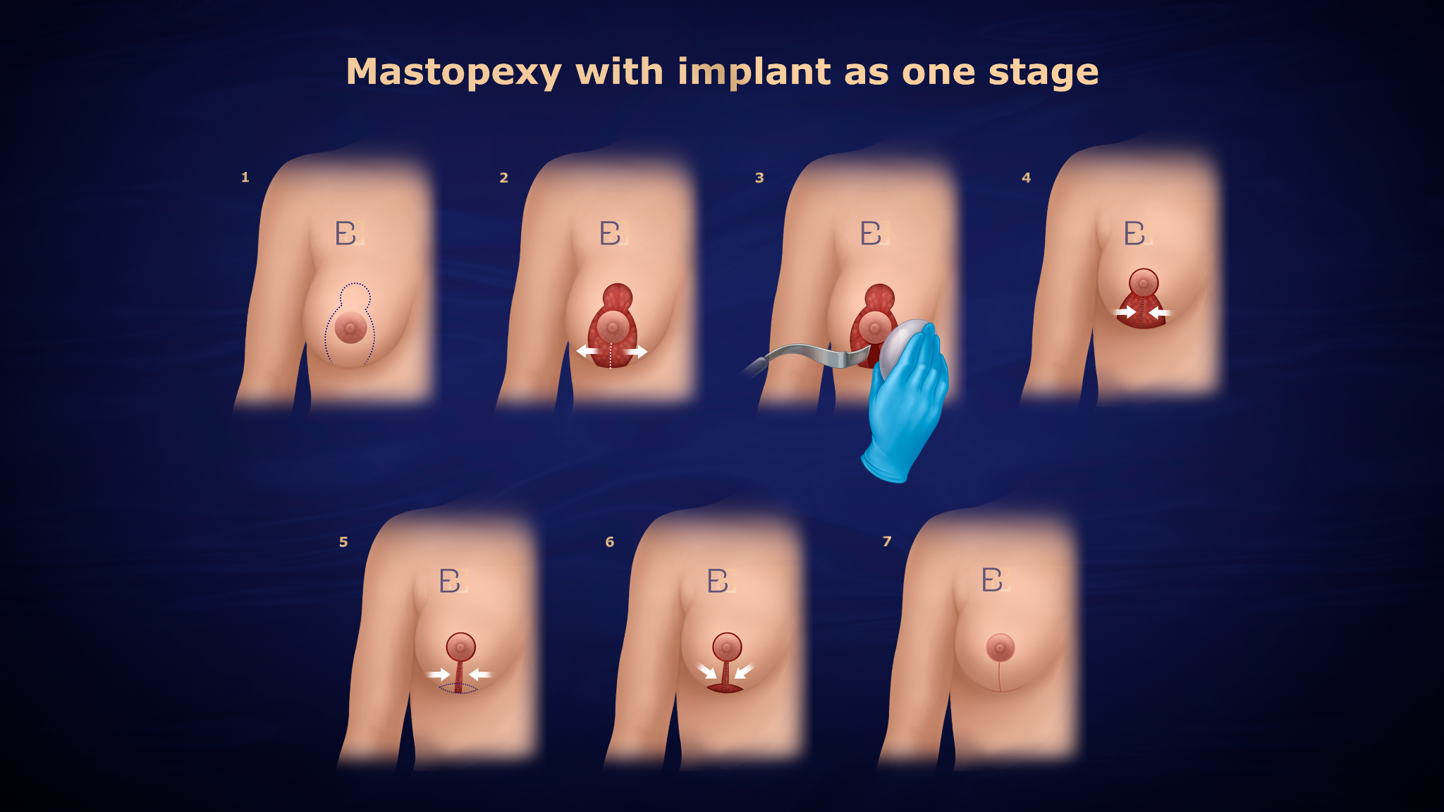 Mastopexy with implant as one stage