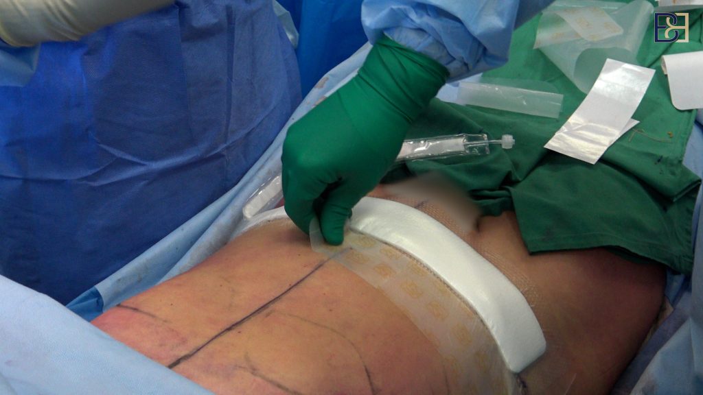 PICO negative pressure dressings 