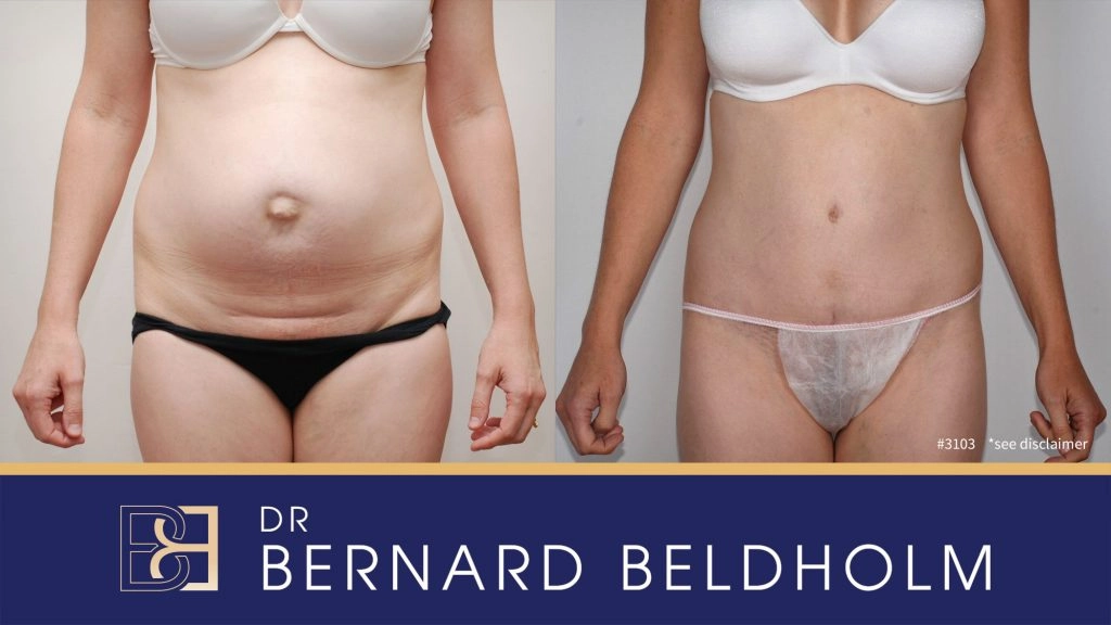 Patient 3103 - Before & After Abdominoplasty