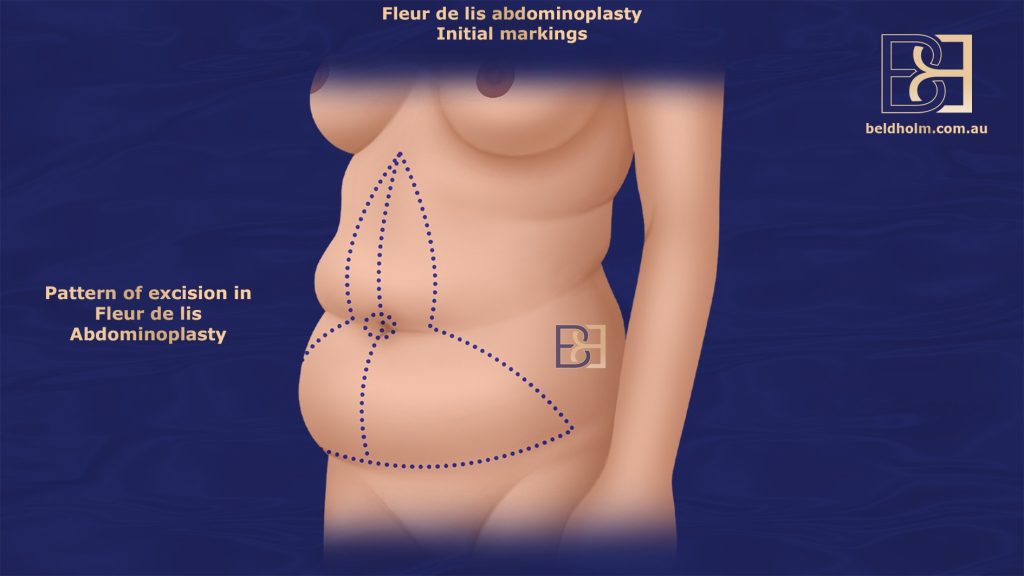 Pattern of Excision in Fleur De Lis Abdominoplasty