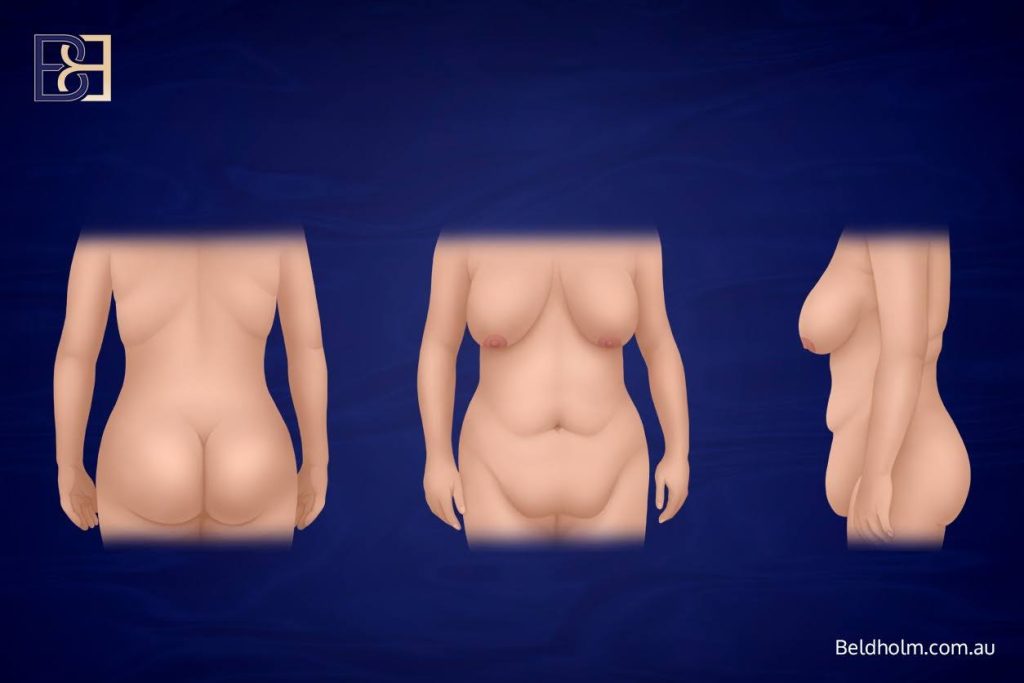 Post weight loss surgery candidate - Dr Bernard Beldholm