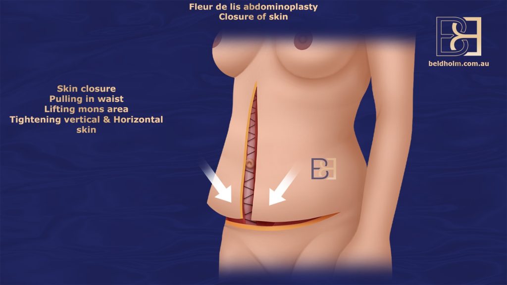 Skin closure after excision of skin in Fleur de lis abdominoplasty