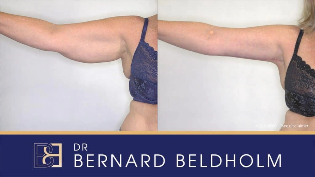 Standard brachioplasty