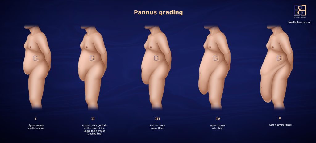 The Abdominal Apron (Pannus) Explained