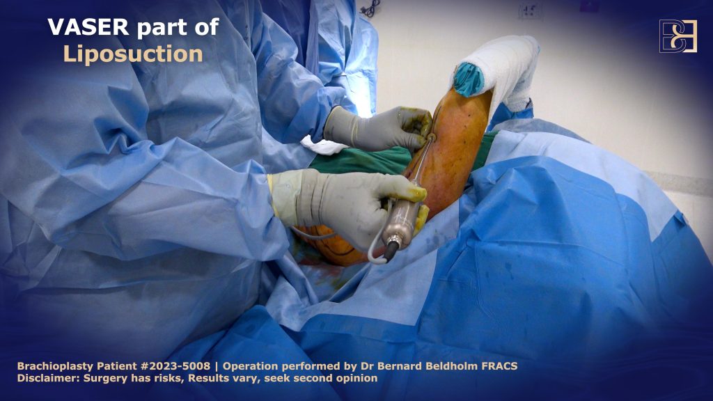 The Role of Liposuction (Suction Assisted Lipectomy)