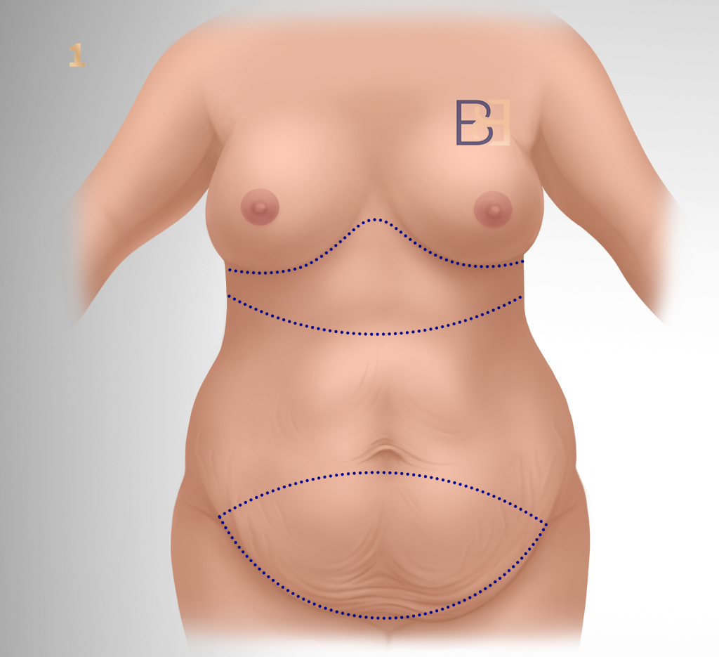 The Two Excisions Explained