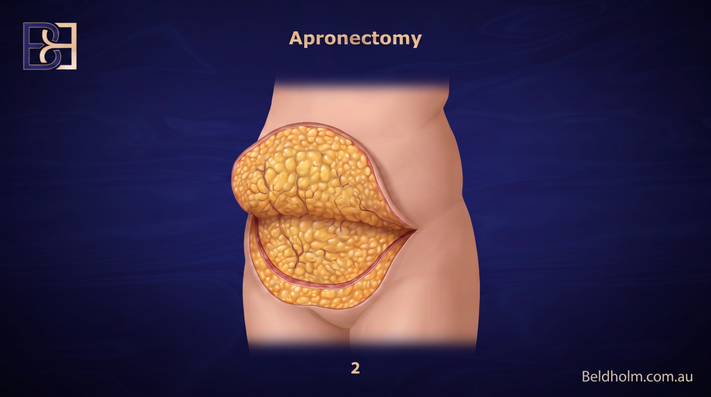 The excision - Apronectomy