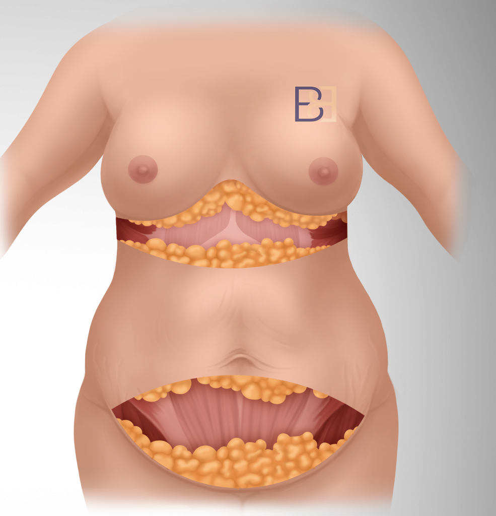The lower excision