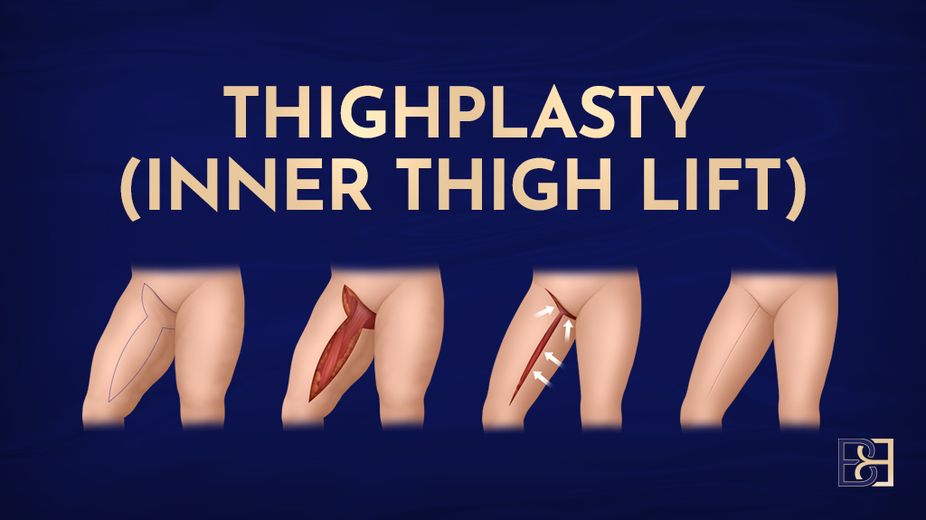 Thighplasty (Inner thigh lift)-featured image