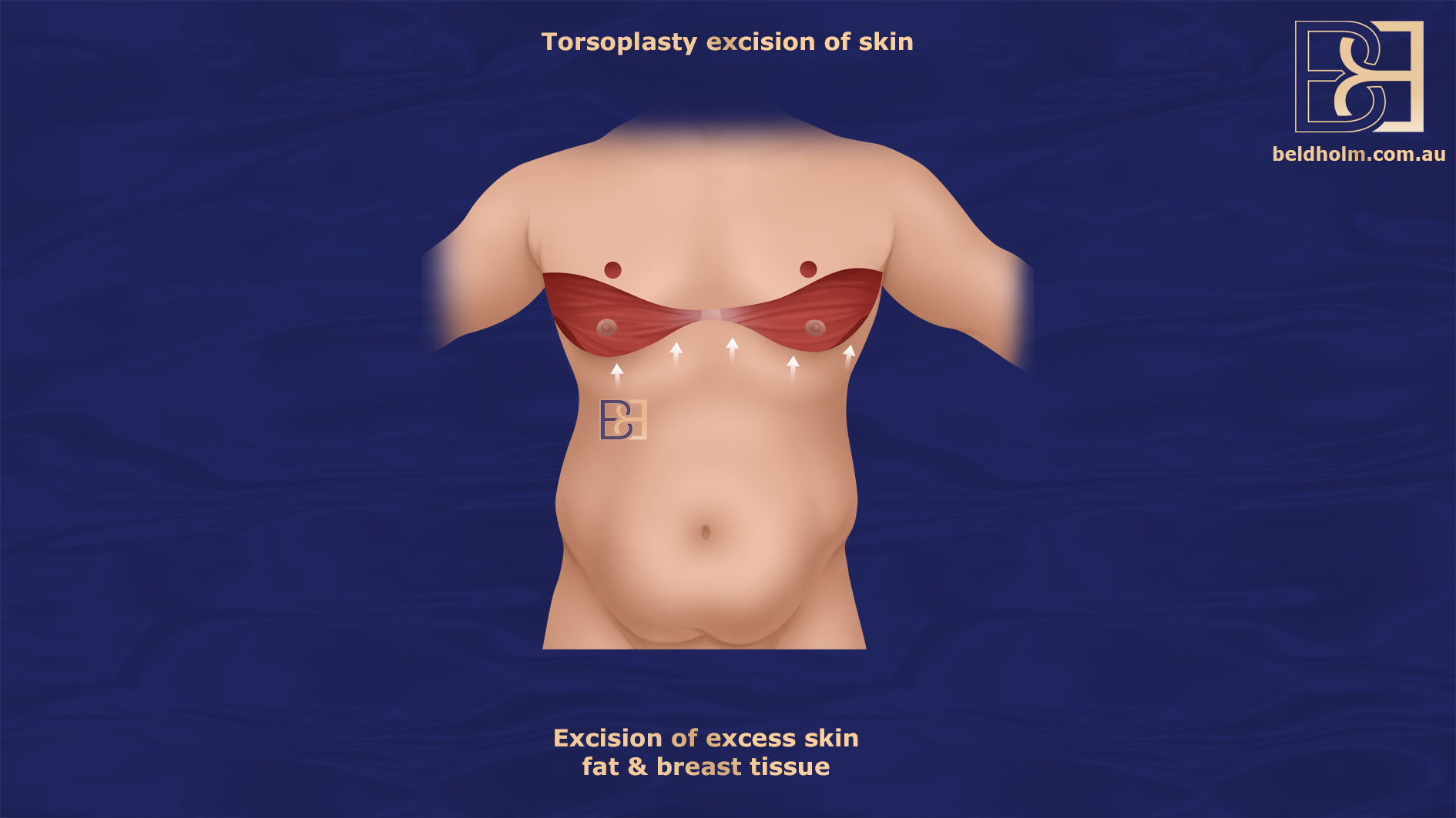 Torsoplasty - Excision of skin - Dr Bernard Beldholm