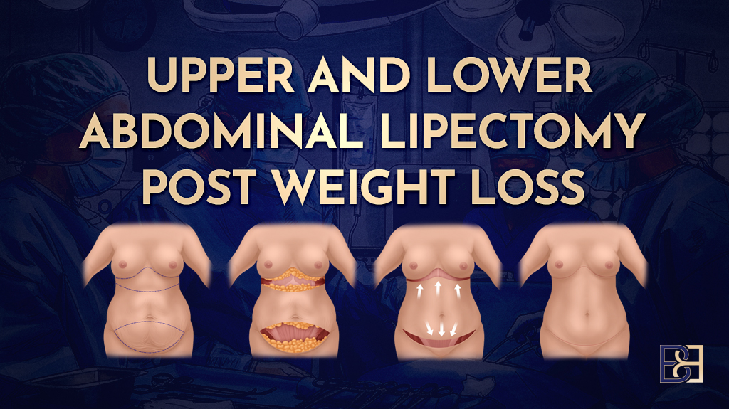 Upper and lower abdominal lipectomy post weight loss-featured image