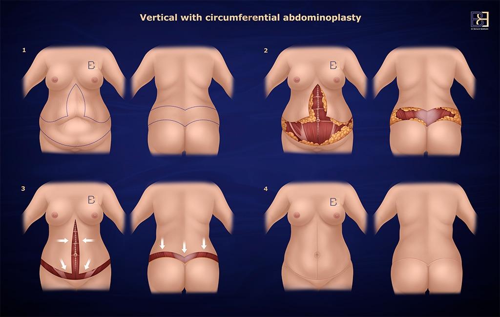 Vertical with circumferential abdominiplasty