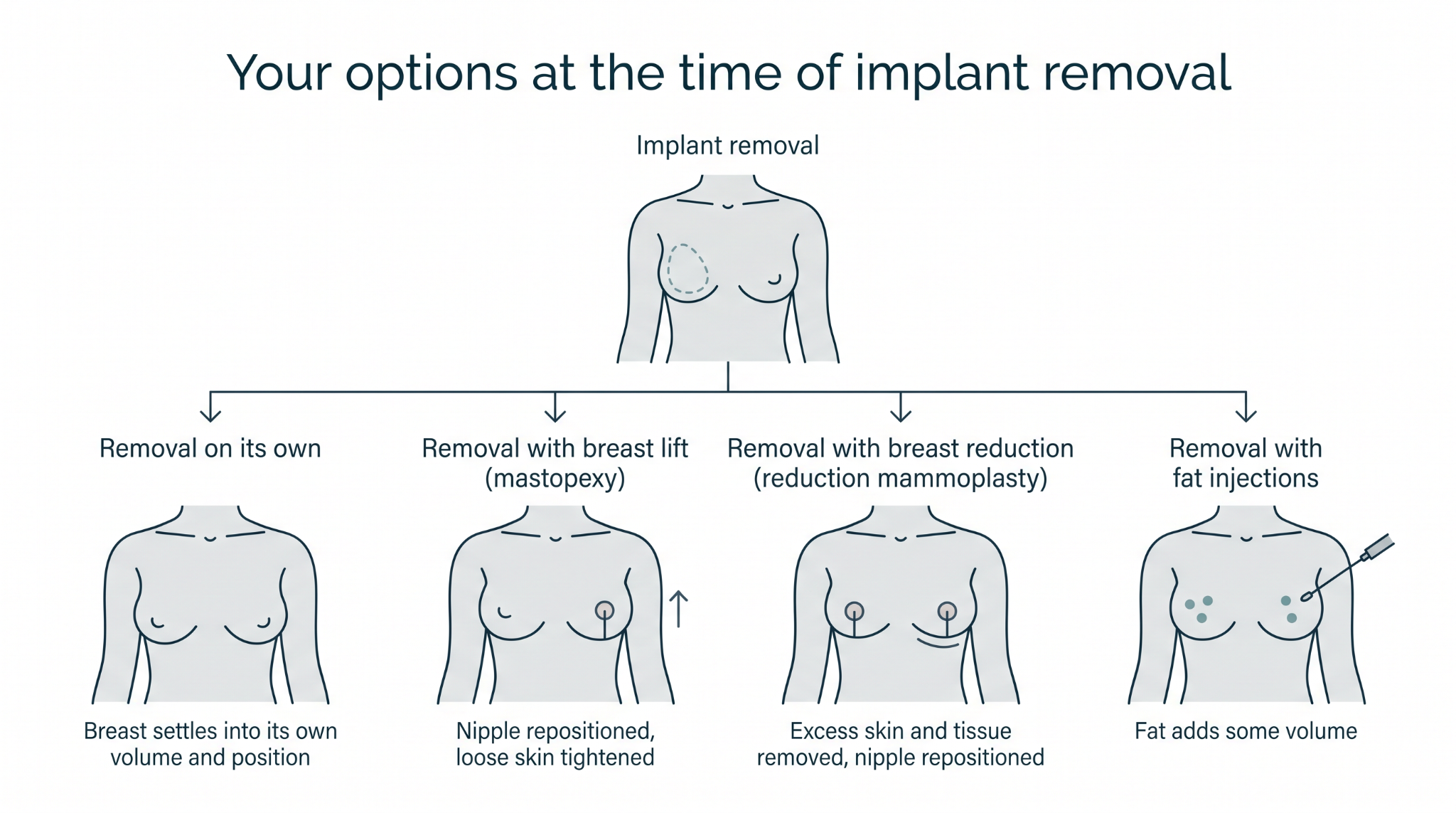 Removal of breast implants (explant surgery)