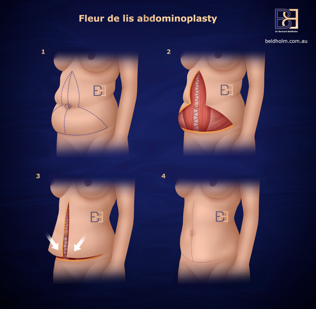 Fleur de lis abdominoplasty technique