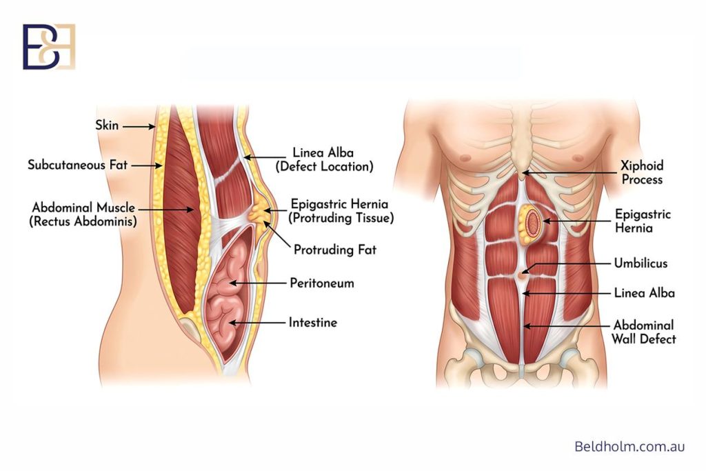 Hernia Repair During Abdominoplasty (Tummy Tuck) After Weight Loss 6 Epigastric hernia