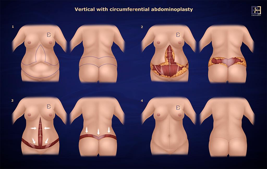 Body lift (belt lipectomy) with vertical excision of skin on anterior abdomen