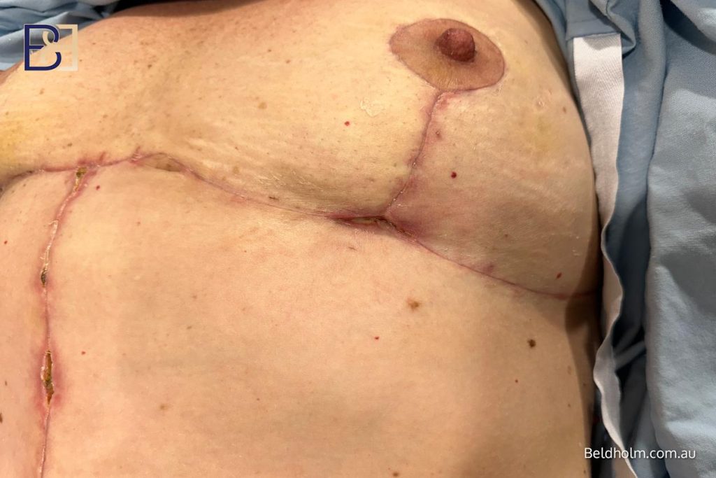 Wound healing and dehiscence
