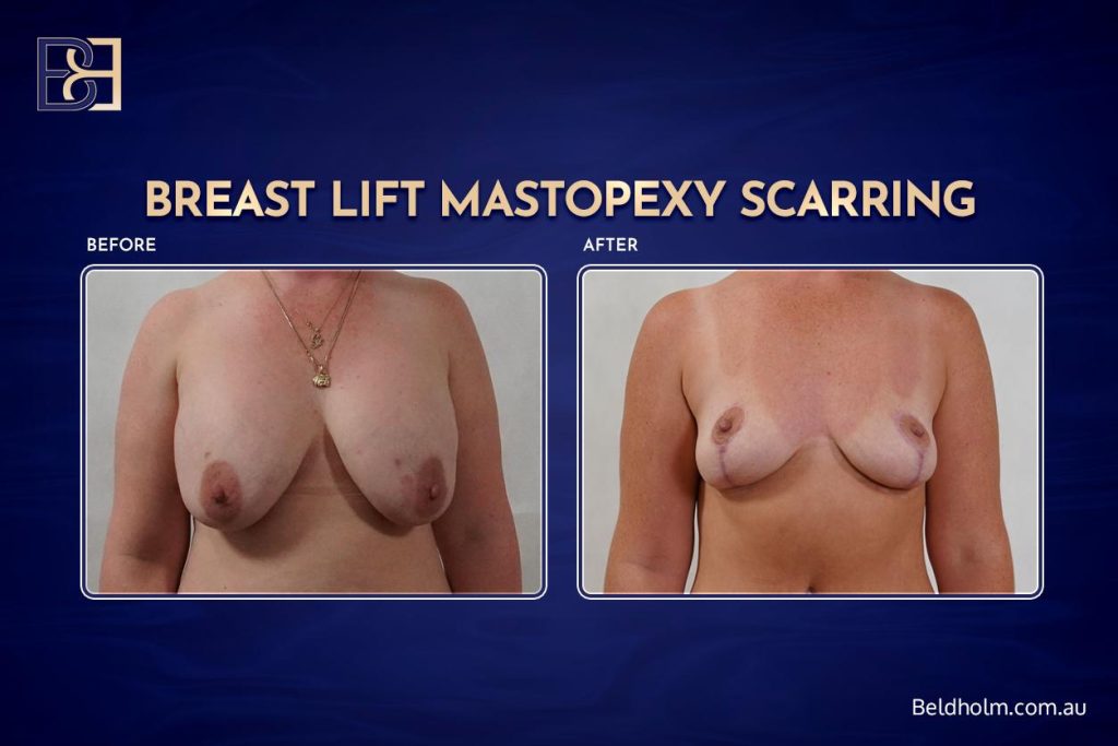 Breast Lift Mastopexy Scarring