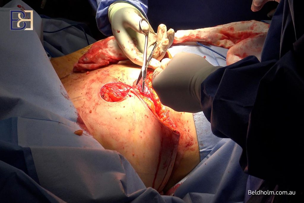 Further surgery