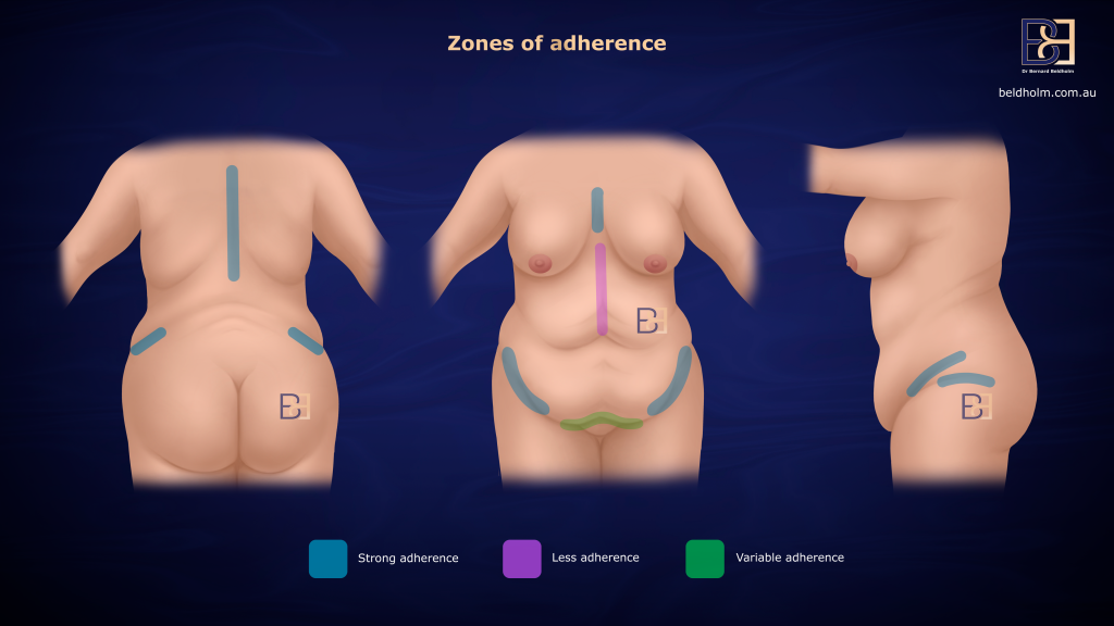 zones of adherence