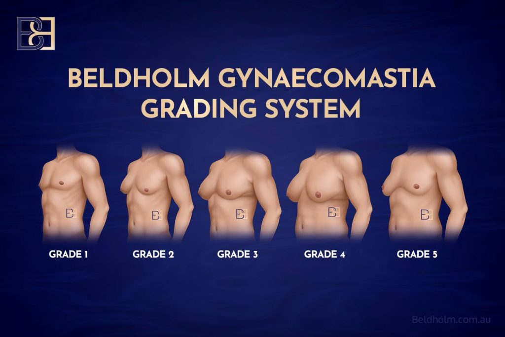 Gynaecomastia Grading system