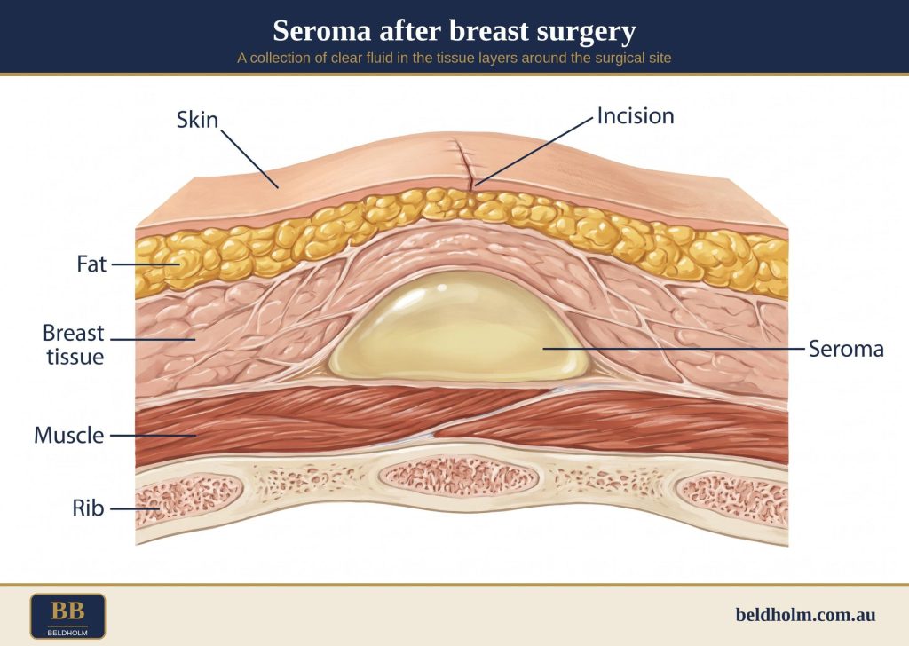Seroma