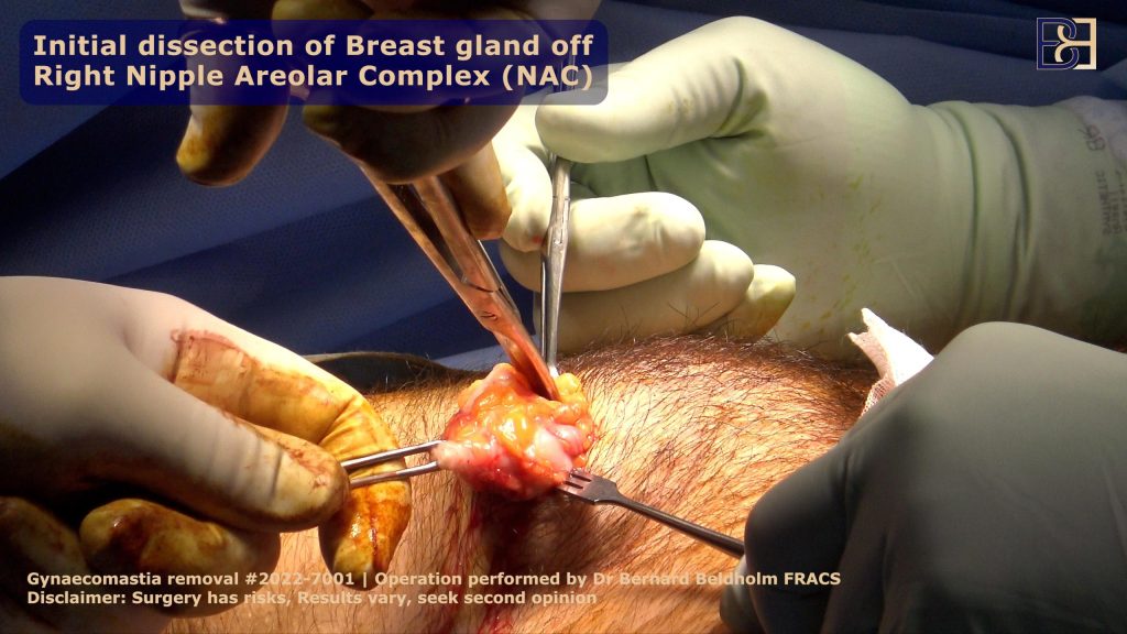 Removing the gland