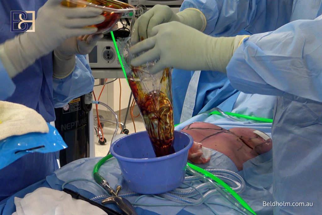 using the keller funnel to insert the breast implant