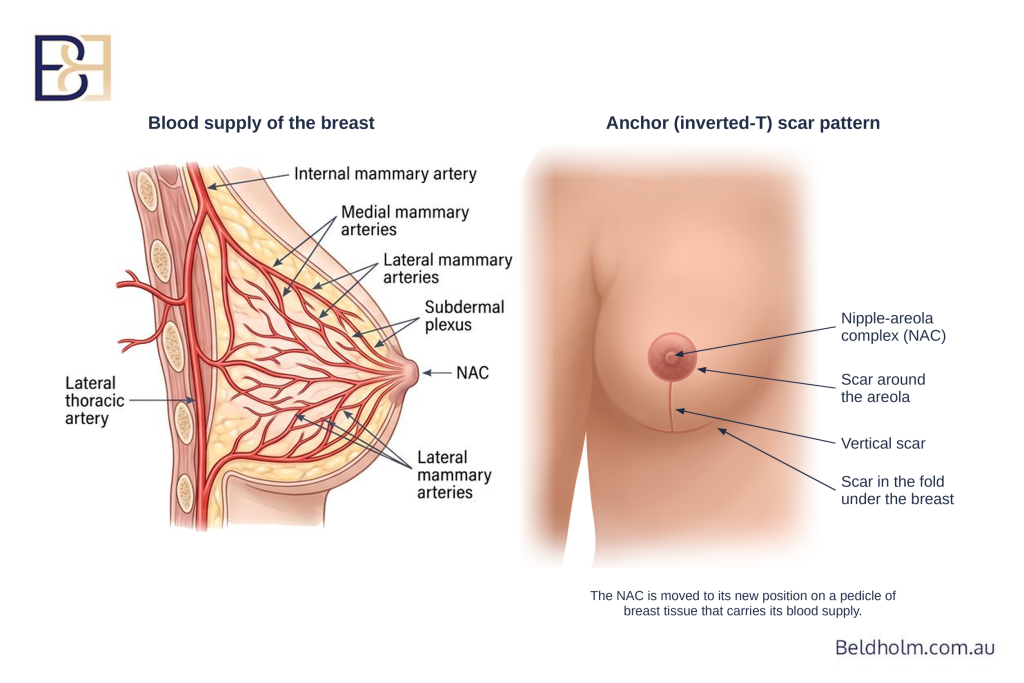 Complications of Breast Implant Removal (Explant Surgery) With a Breast Lift (Mastopexy) 5 Blood supply that has already been altered