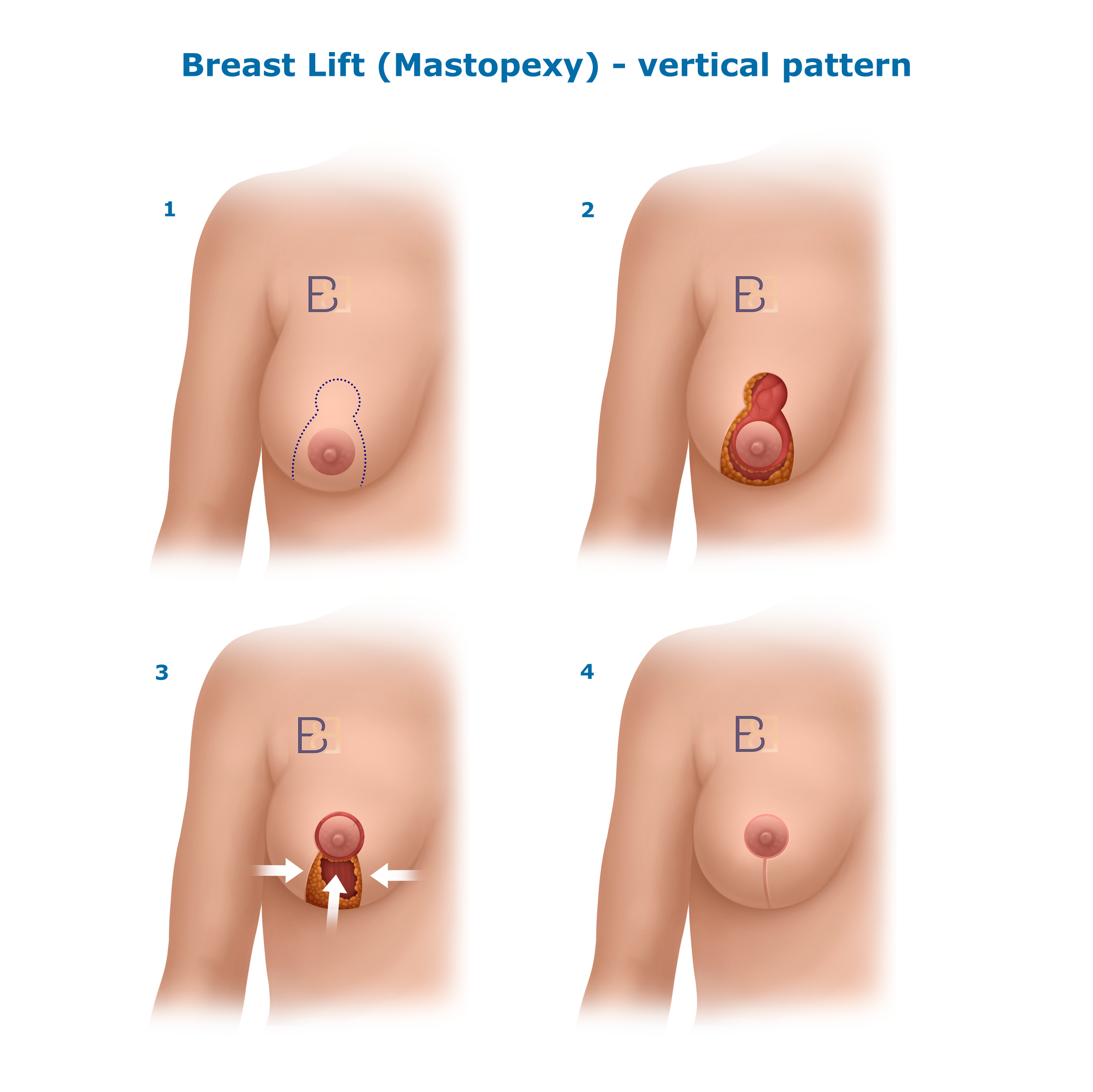 Recovery After Breast Implant Removal (Explant Surgery) With a Breast Lift (Mastopexy) 3 Breast Lift (Mastopexy)